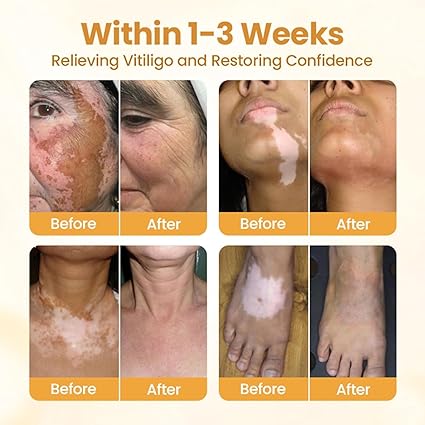 π Bee Venom Vitiligo Cream