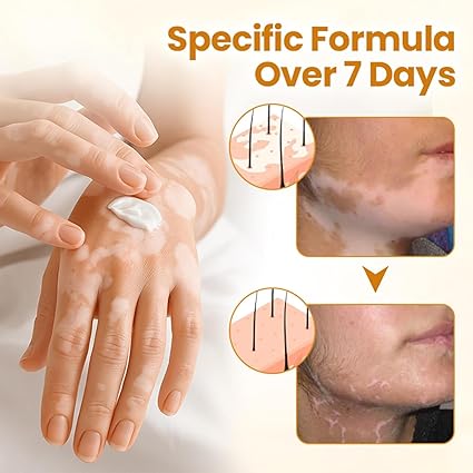 🐝 Bee Venom Vitiligo Cream