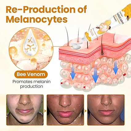 🐝 Bee Venom Vitiligo Cream